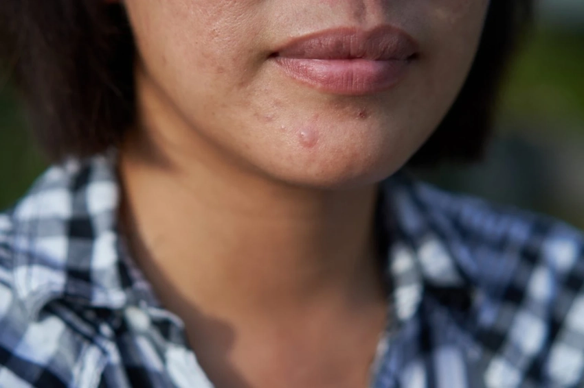 Что означает прыщ на подбородке: приметы для женщин и мужчин